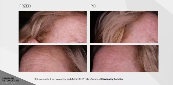 MESOBOOST-przed-po-1