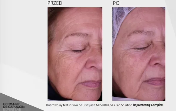 MESOBOOST-przed-po-2